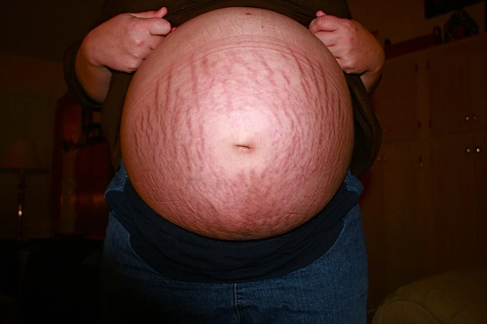 Pregnant woman flaunting her stretch marks