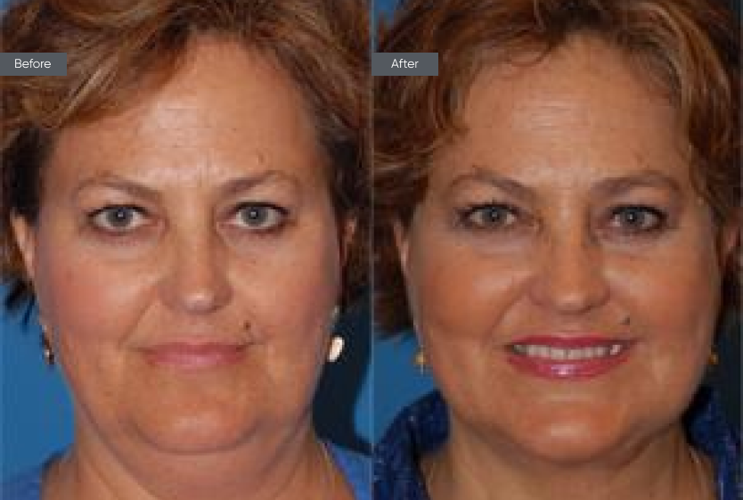 Liposuction - Before&After