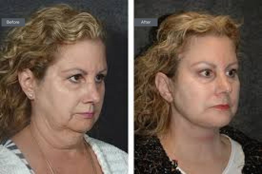 Neck Lift - Before&After