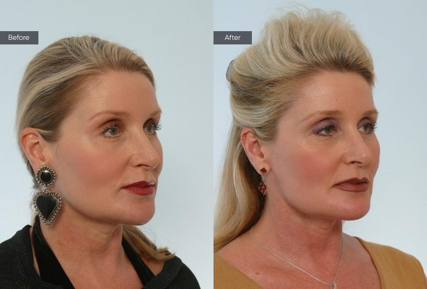 Neck Lift - Before&After