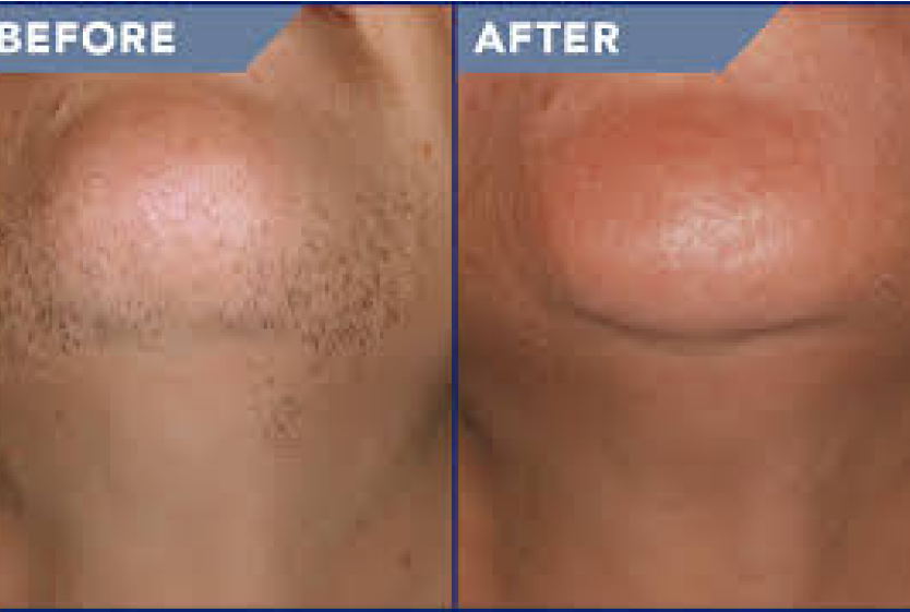Laser Hair Removal - Before&After