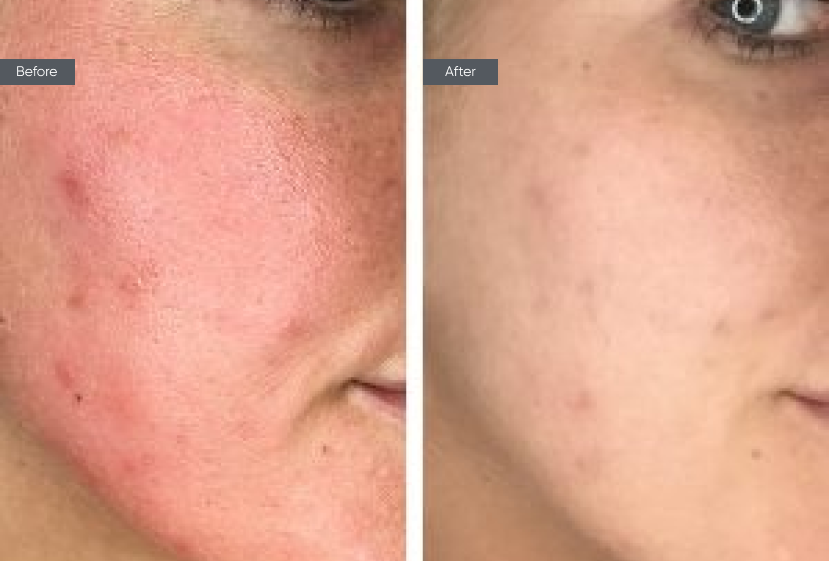 Chemical Peel - Before&After
