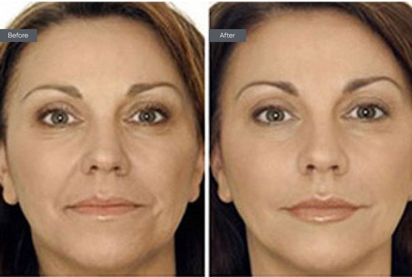 Facelift - Before&After