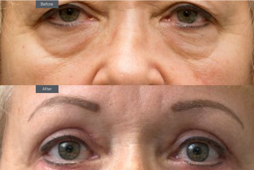 Eyelid Surgery - Before&After