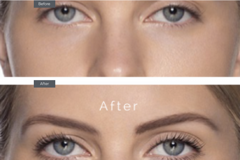 Eyelid Surgery - Before&After